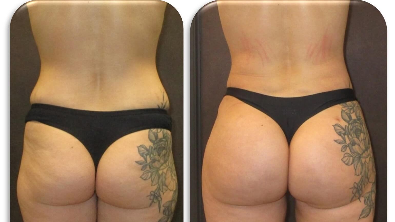 before and after fat grafting